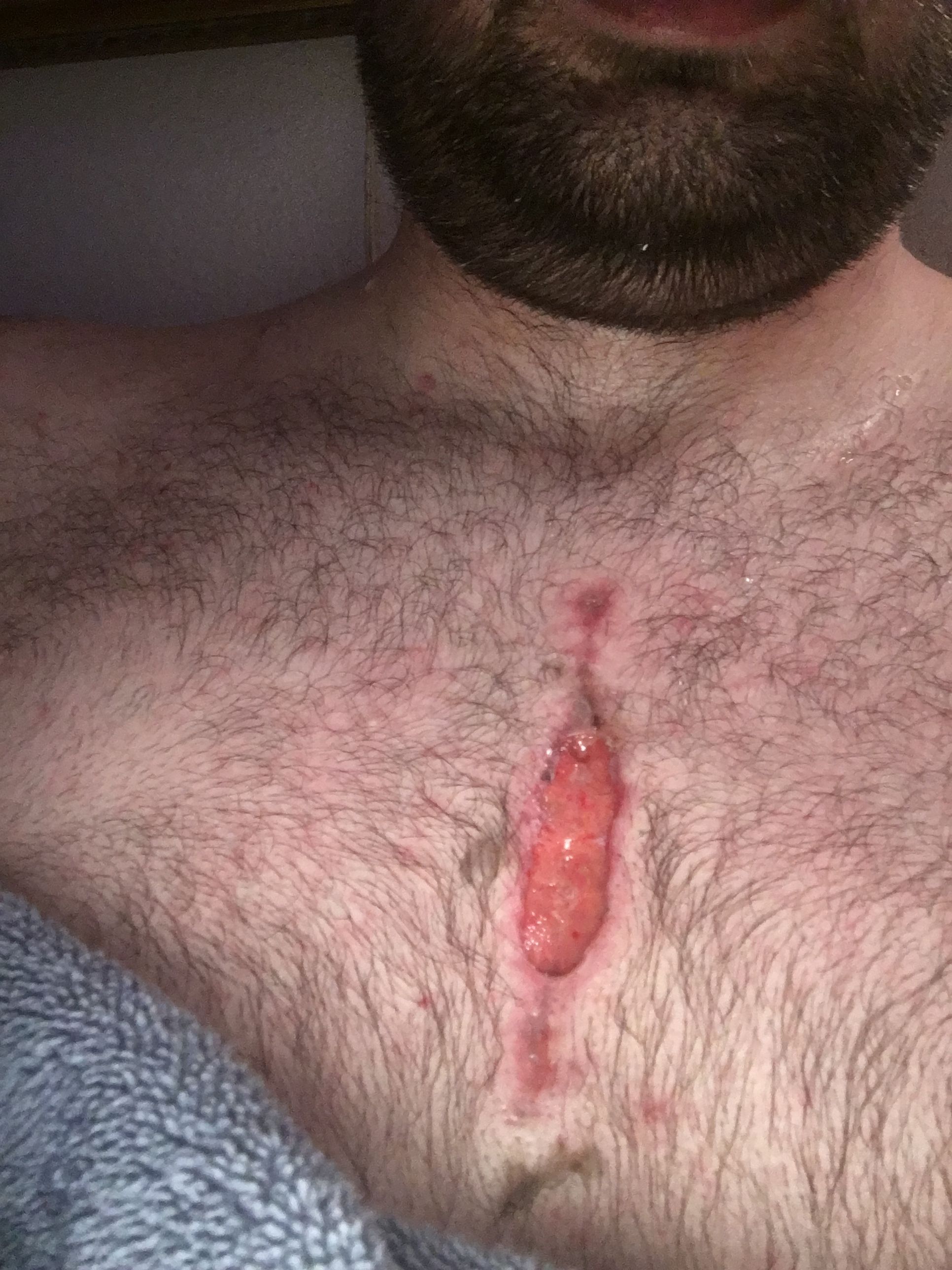 This is what happens when your stitches dissolve before they should. I think my body hates me.lol