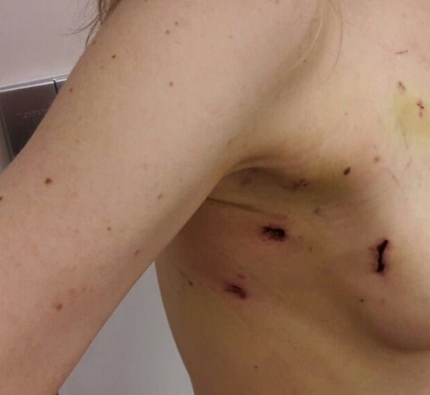 My incision 8 days after surgery