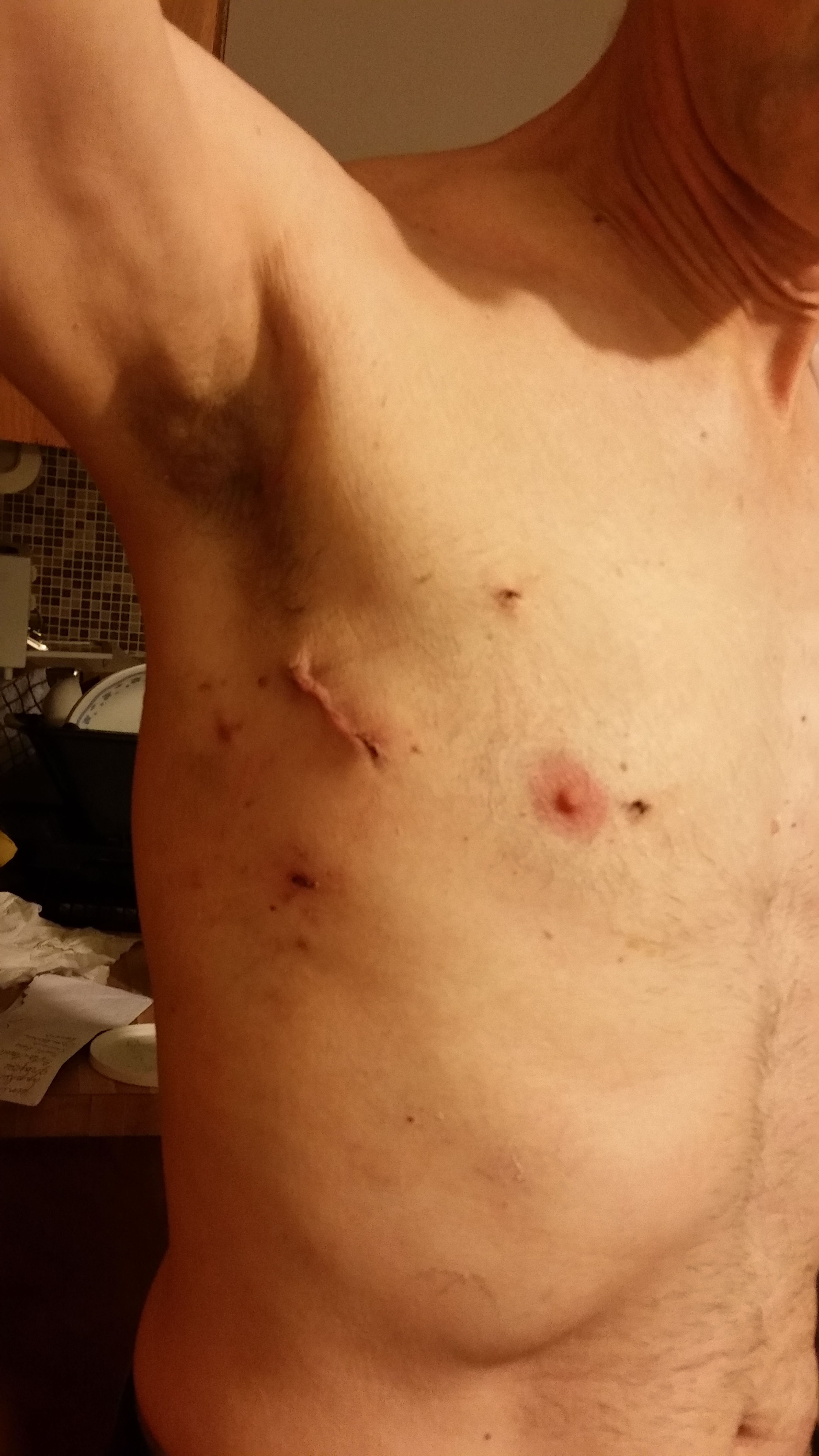Didn't make the zipper club, but these are robotic scars at 2 weeks post op