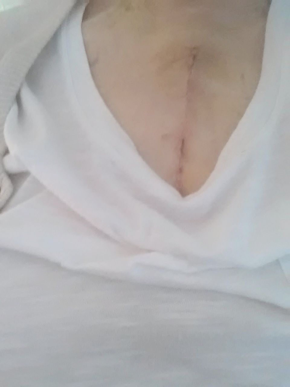 My scar, day 10