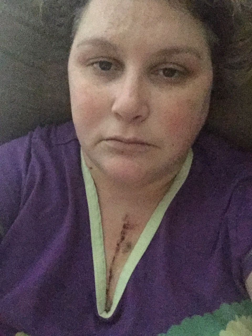 One week post op, almost to the minute. Feeling better today, just super tired.