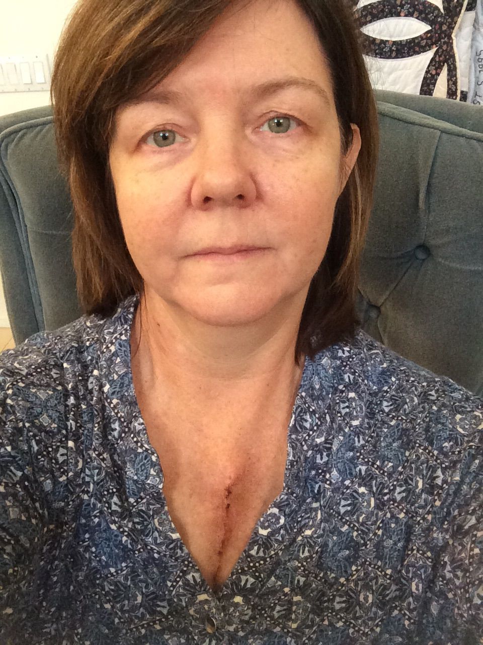 My scar at two weeks post surgery