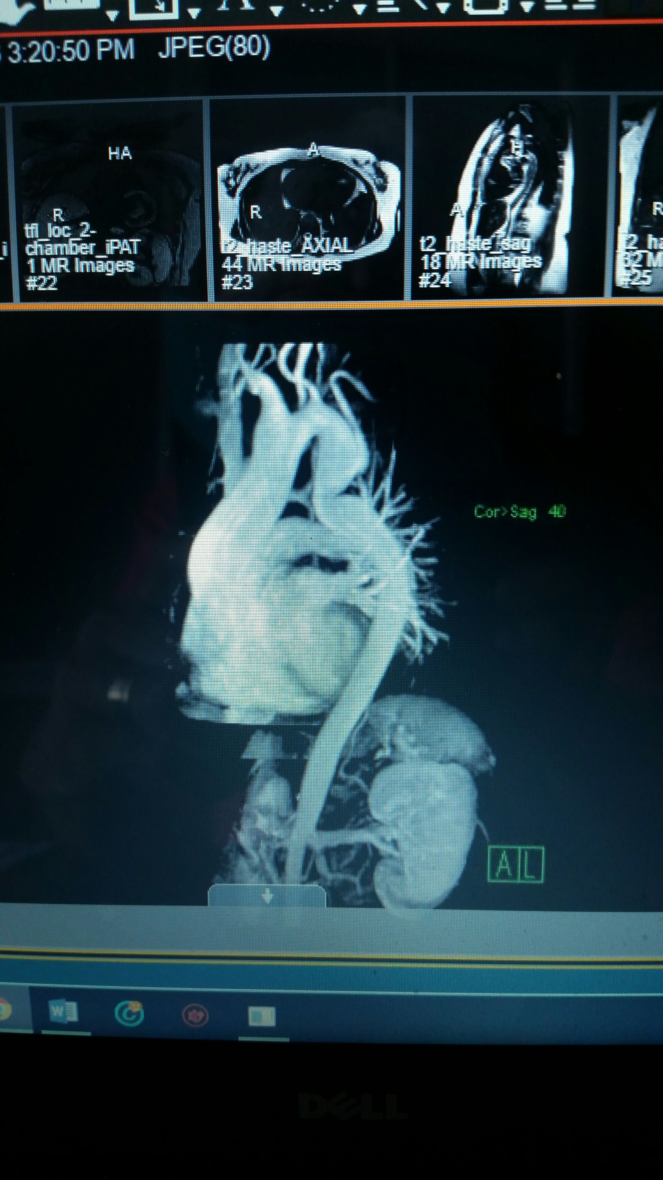 this is a pic of my previously undiagnosed aortic coarctation. Anyone else have this?