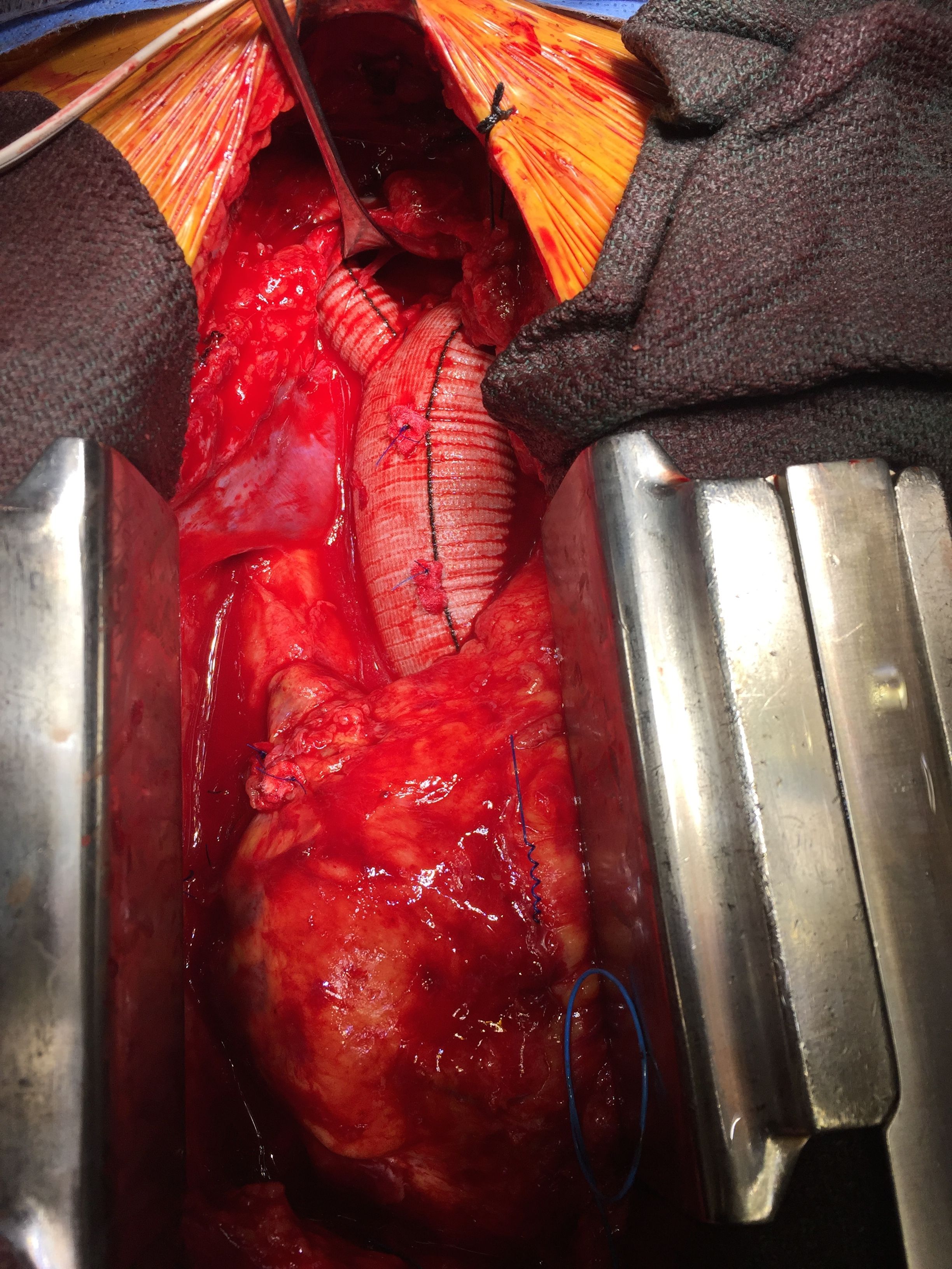 My surgeon was kind enough to take pics of my surgery. They had just restarted my heart when this was taken. Dacron aorta graft is what you see.