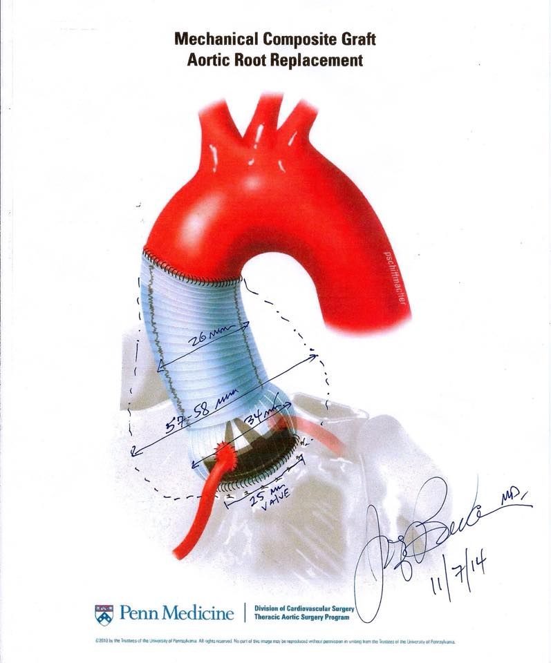 This drawing was done by my surgeon during a post-op visit for surgery #2. I had an aortic valve replacement (St Jude) in 1989. After many years of trouble-free ticking, I was then diagnosed with an ascending aortic aneurysm. My aortic valve, aortic root