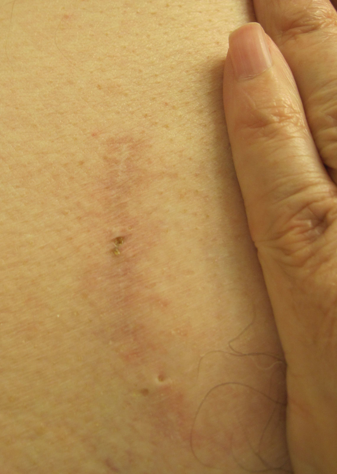 This is the main incision 13 months after endoscopic MV repair via right side minithoracotomy. It is about 2.5 inches.