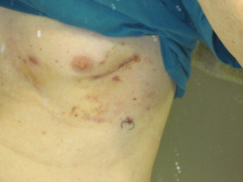 Approx 2.5 inch right-side thoracotomy incision for my mitral valve repair.