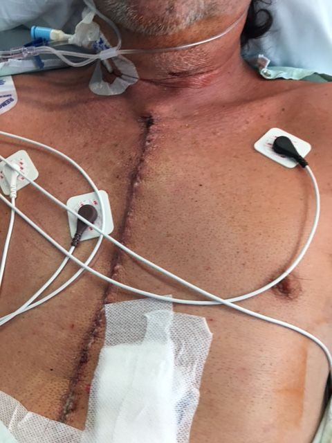 My Scar:

OHS D+1...(1/19/17)