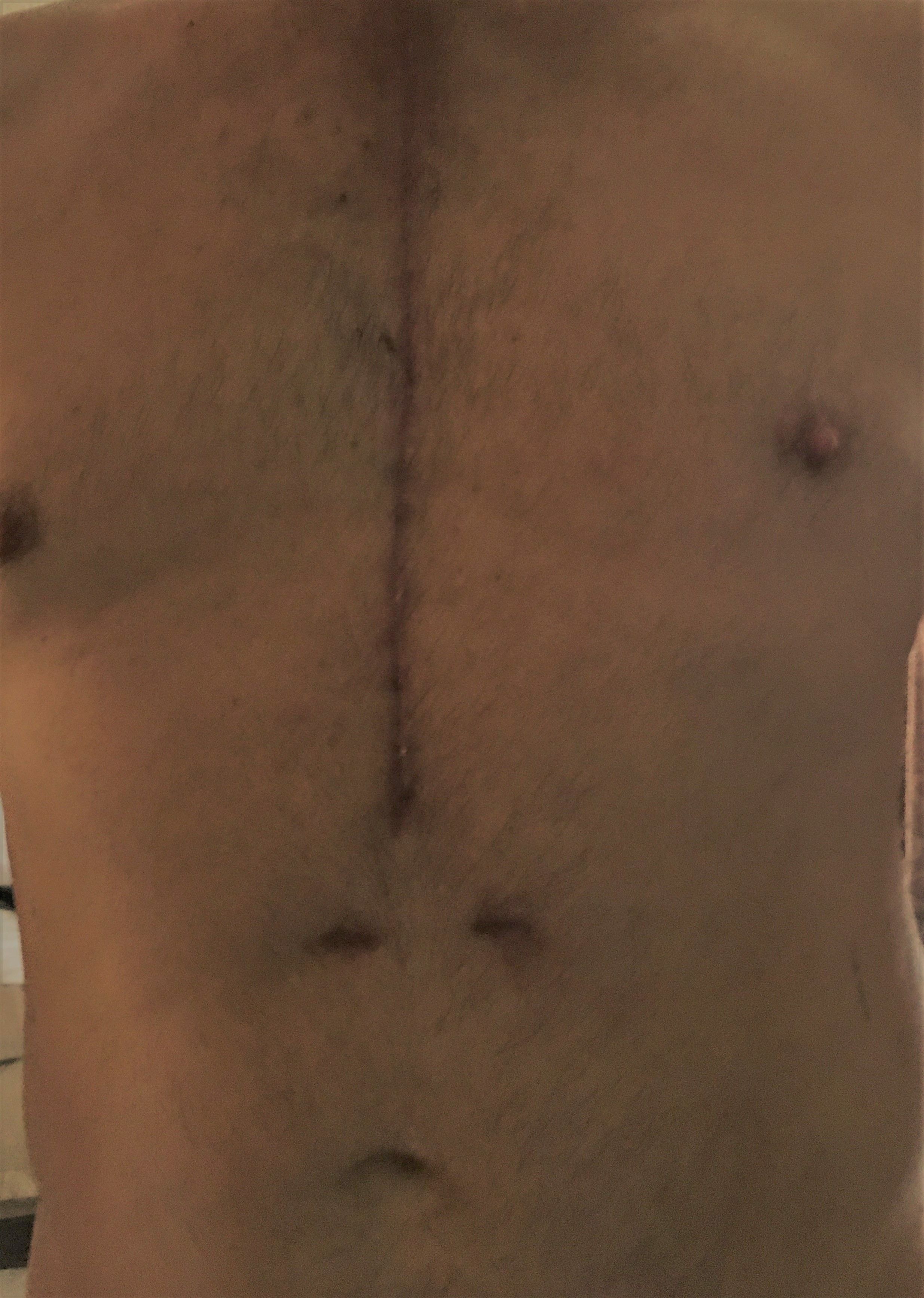 My Scar:

OHS D+42...
