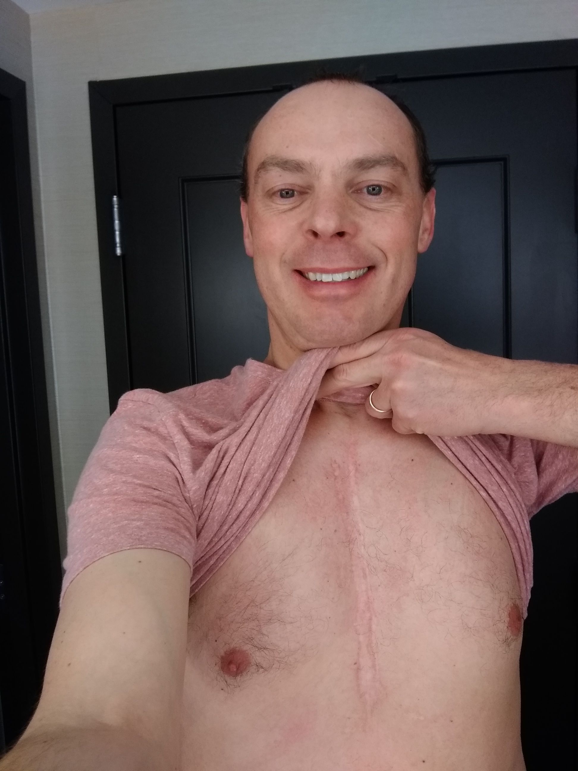 This morning I will earn my 3rd and final badge ....I will be receiving a Molody bovine pulmonary valve and tricuspid valve repair. This site has been a great encouragement for me. Thanks for all the help. With God We will conquer!!