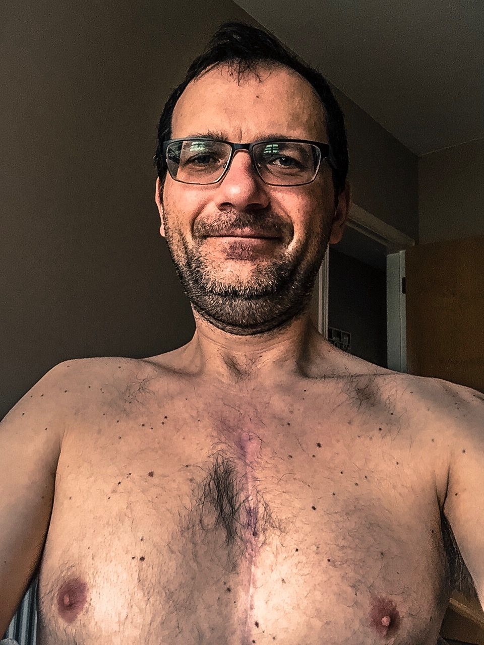 Sun, 26th February 2017
Enjoying home aAlmost one year since my heart surgeries