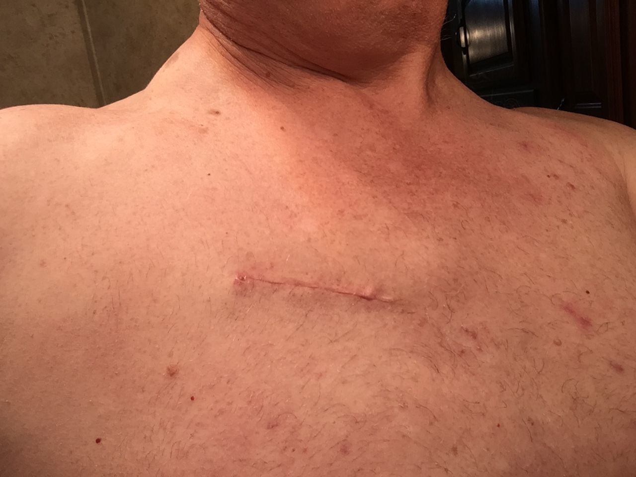 Incision from Minimally invasive Aortic valve replacement 5 and a half weeks ago.
