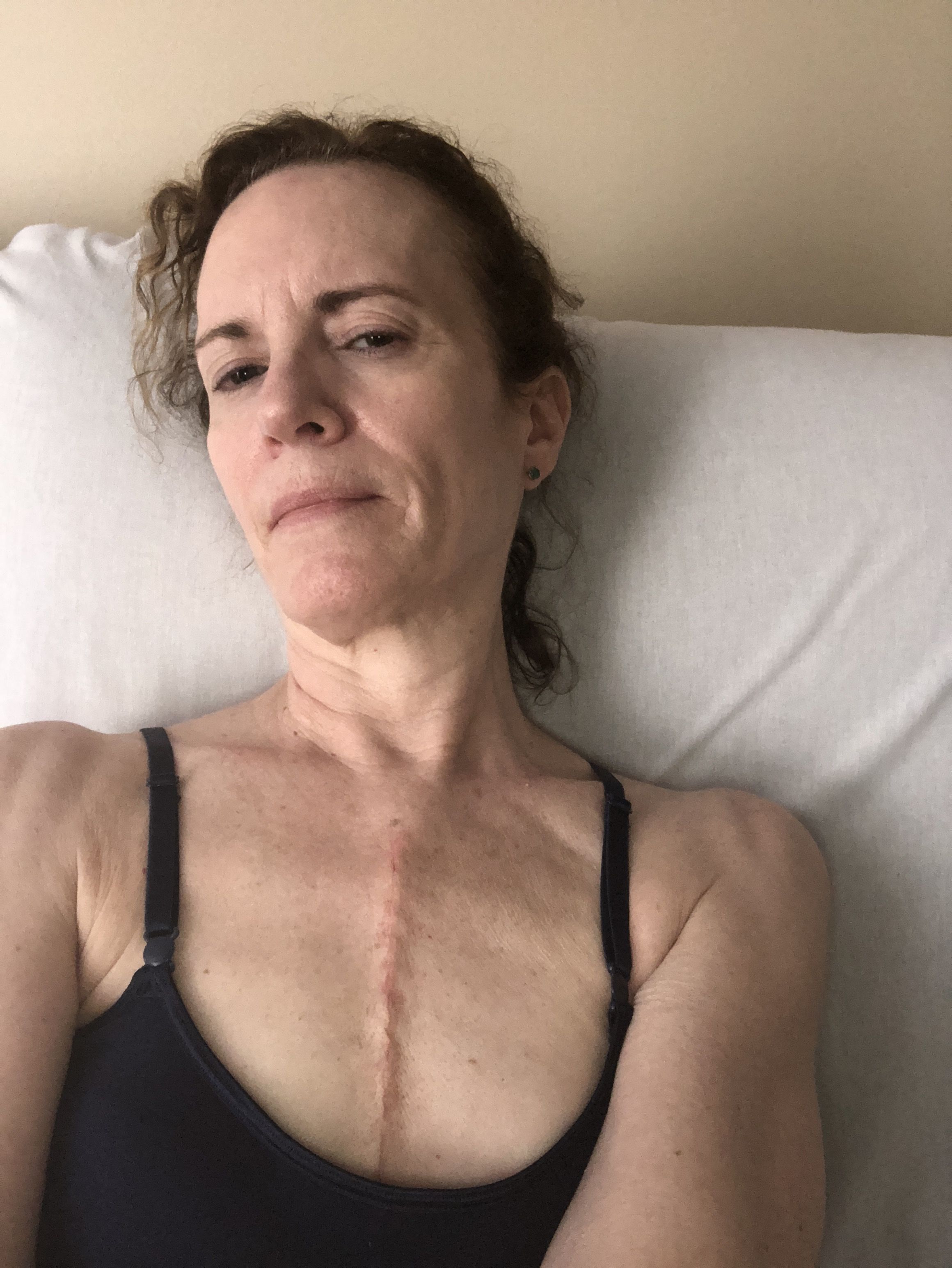 4 weeks post op