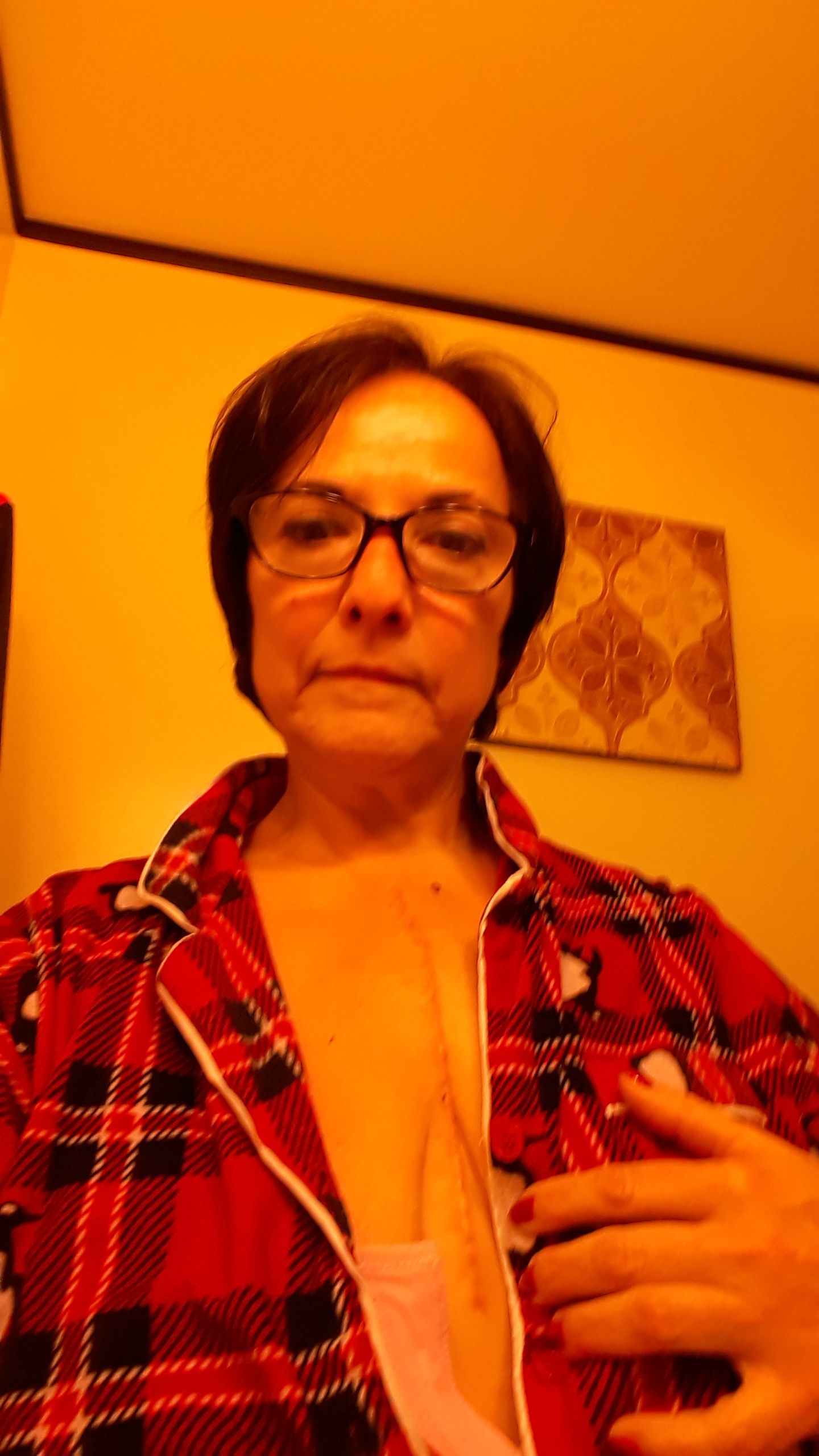 4 weeks post-op. Incision is a bit bigger than the last aortic valve replacement done a few years back.