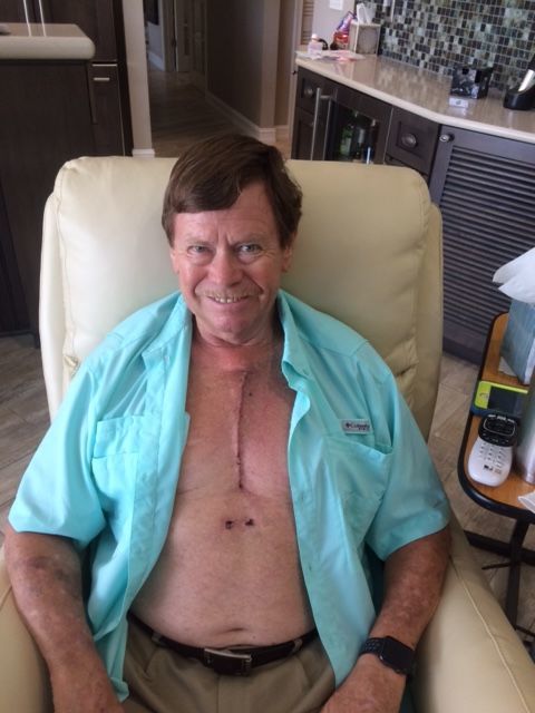 Here I am 15 days post op.