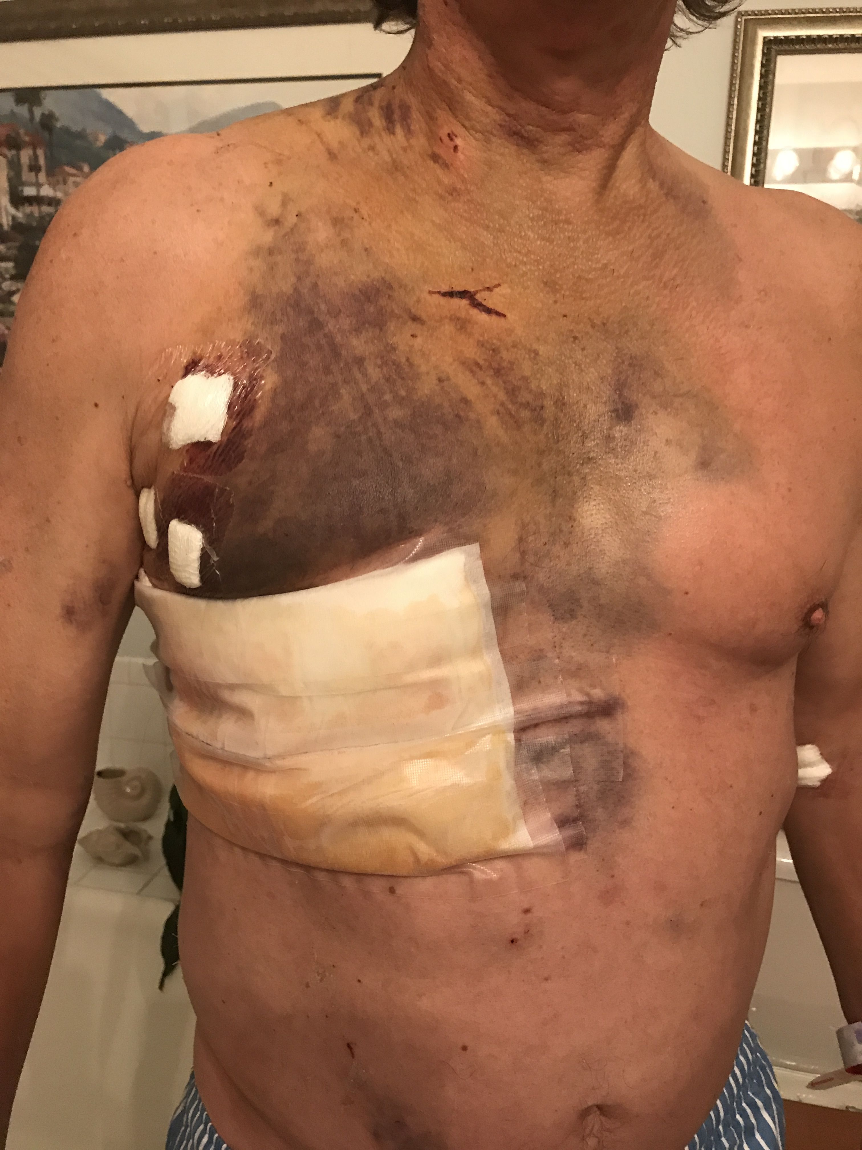 Four day post op for mitral valve repair with bandages over the robotic arm ports and a large gauze pack over the drainage ports. My weight was 10 pounds heavier than pre-op with extra fluid that eventually diminished over the next week.