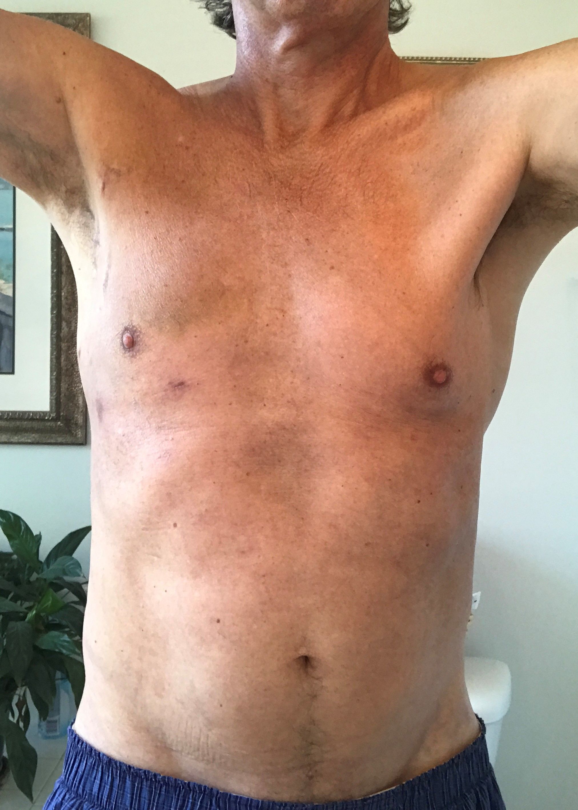 Five weeks post op with significantly reduced bruising. The robotic entry ports and the drainage tube sites are healing. There is still numbness and and sensitivity in the right chest but there is much progress over the past five weeks.