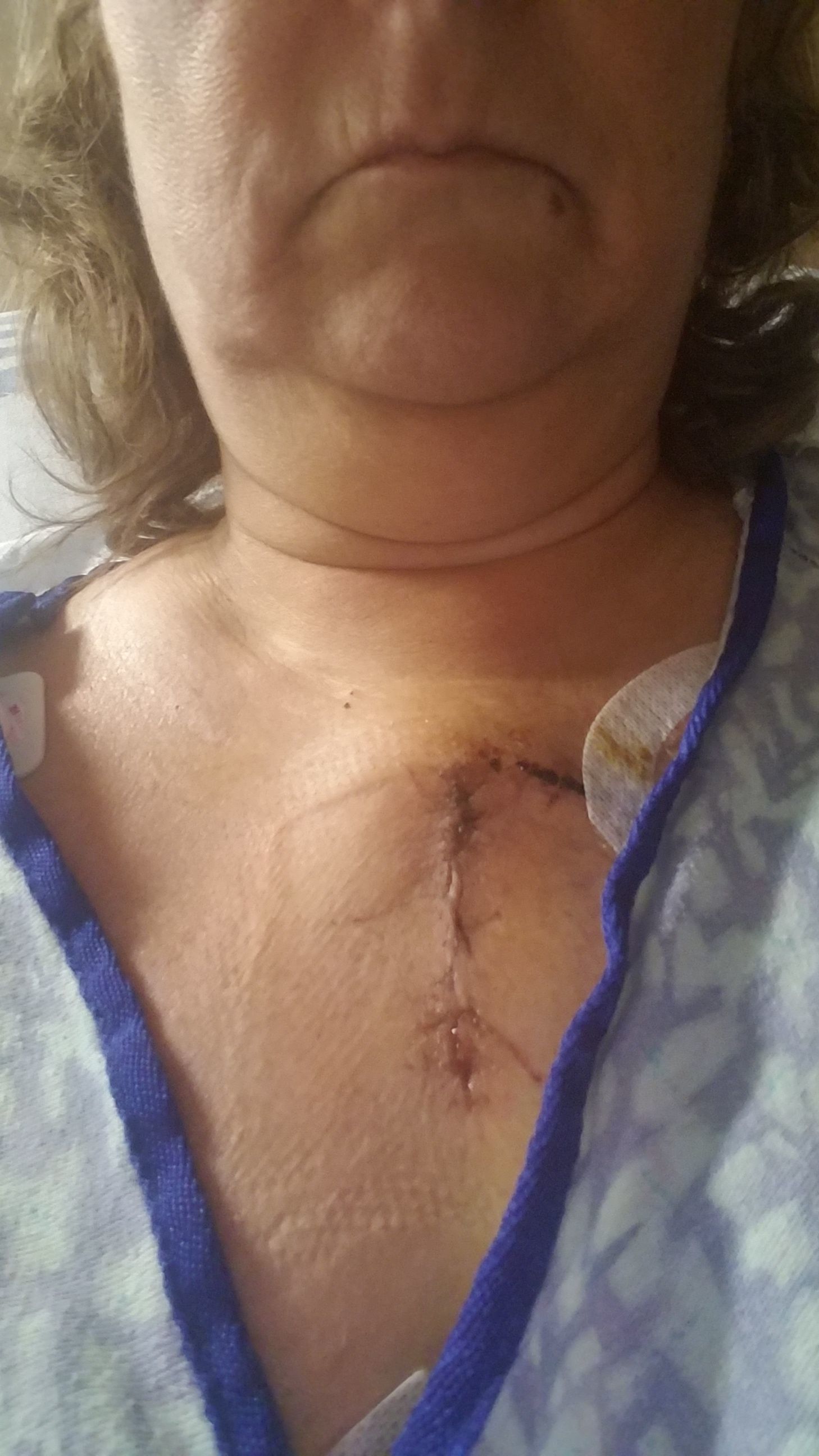 Show Me Your Scar Picture. That's it, just 3 - 4 inches long and healing nicely.