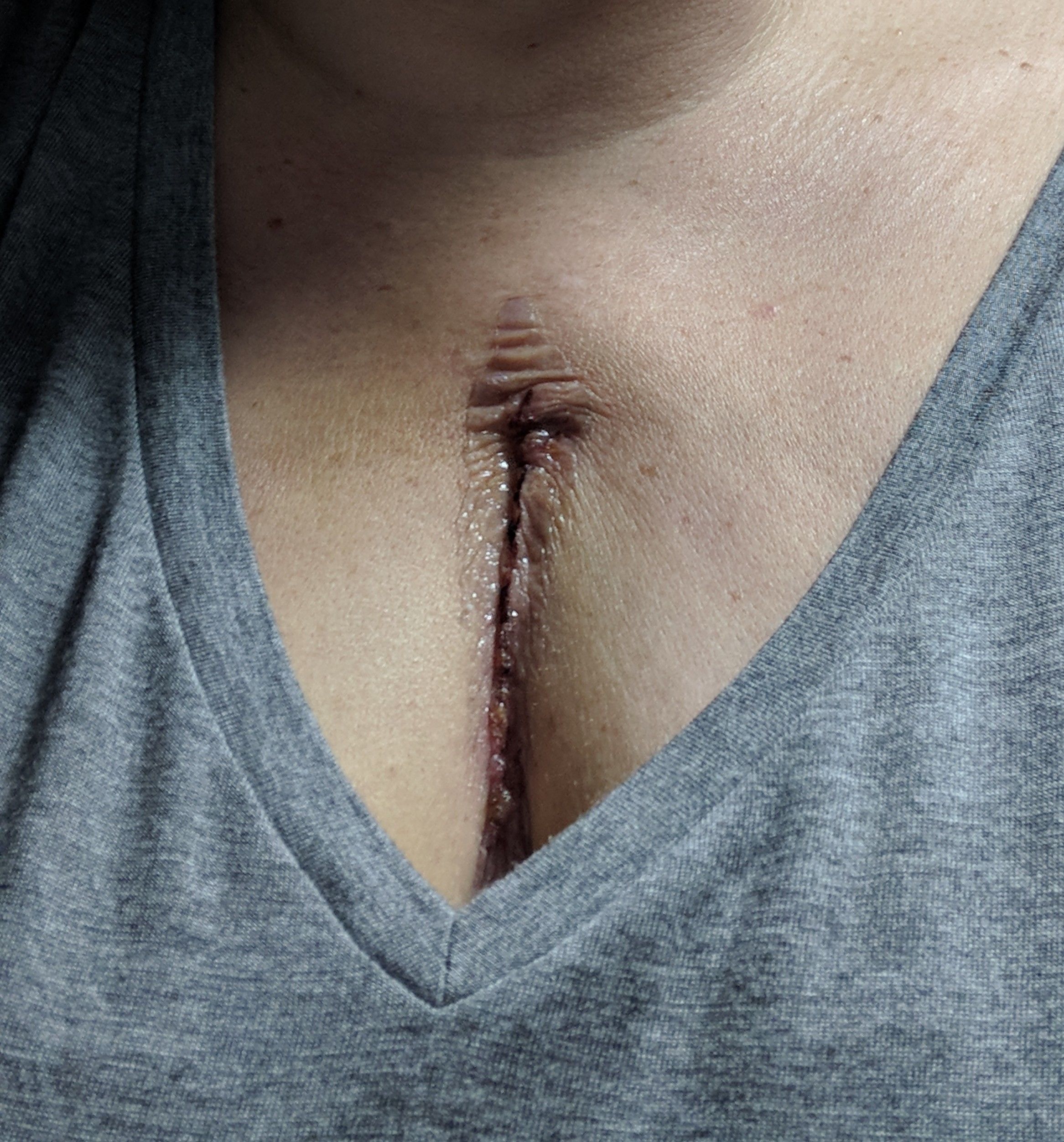 Incision from Jan. 22 surgery