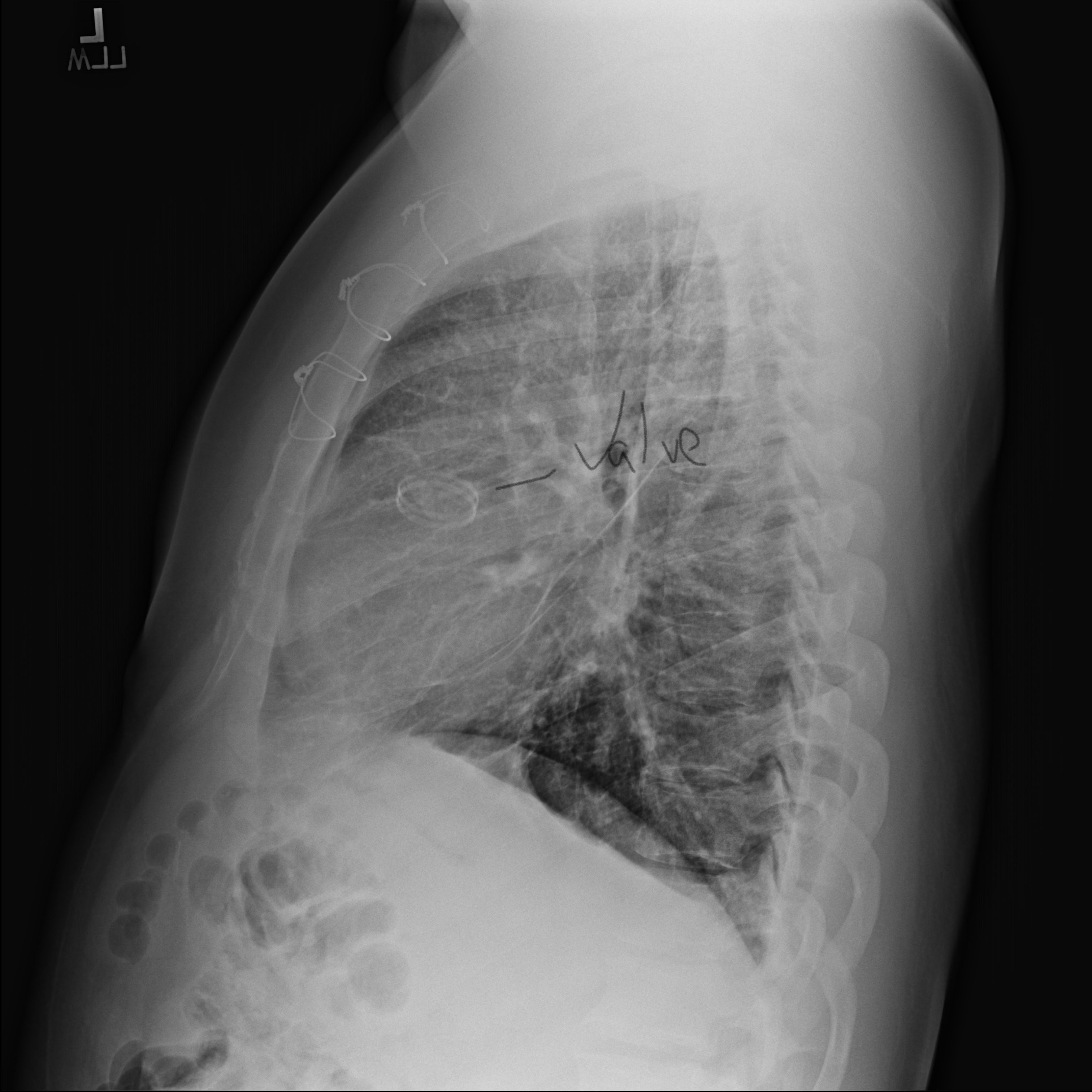 Side view of x -ray - Sternum wires and On-X valve.