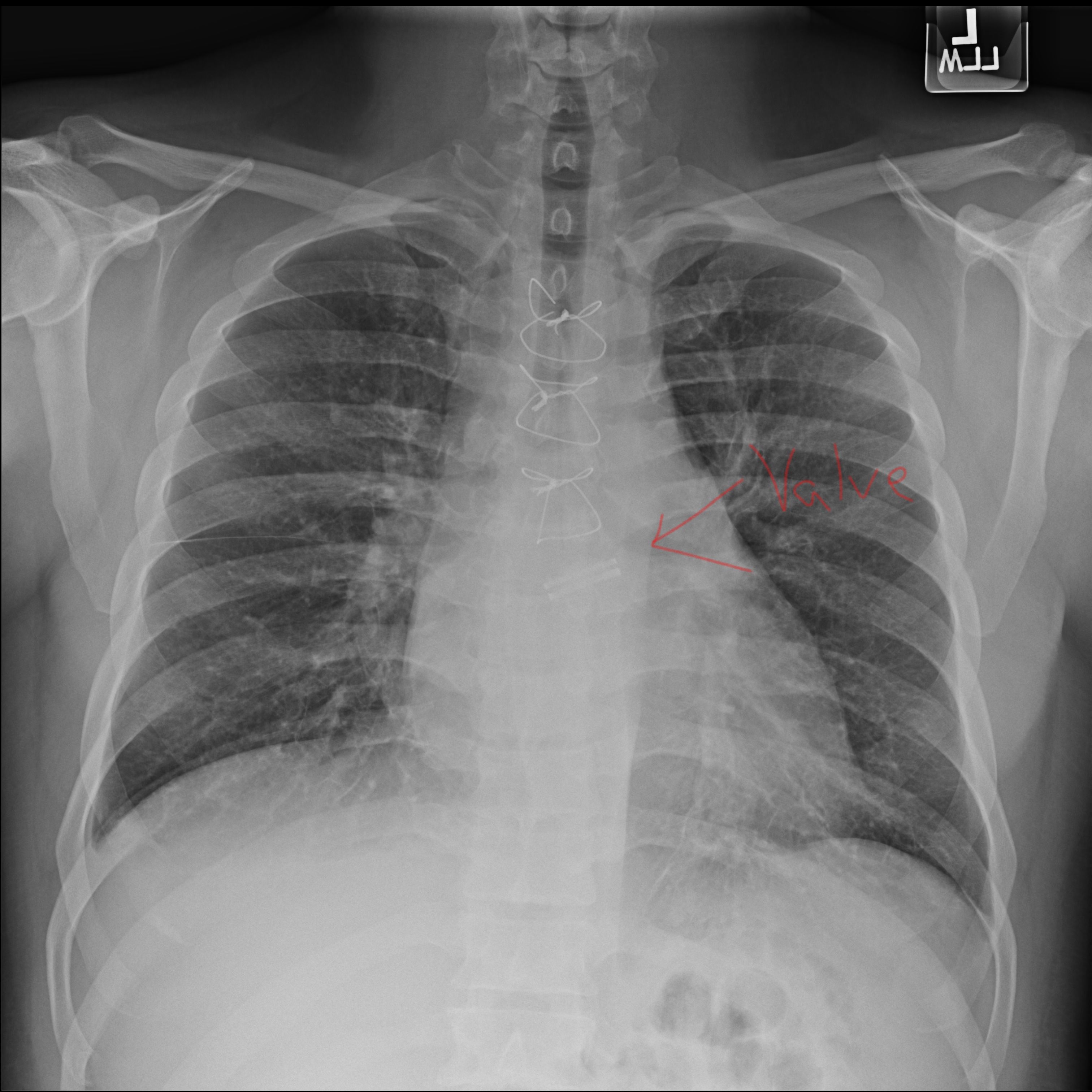 After seeing Lisa's post of the sternum wires I had to check mine out too!! haha