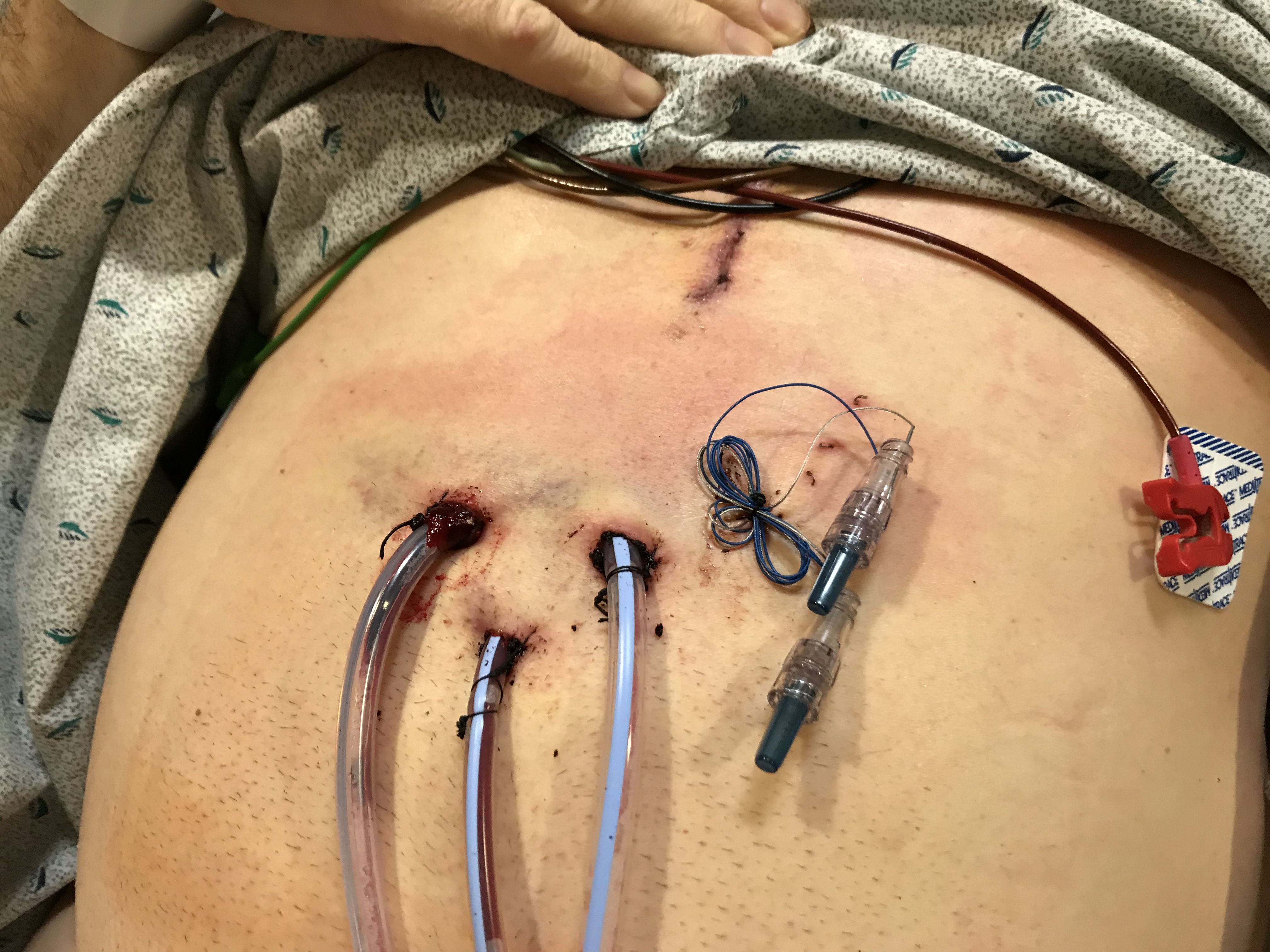 Feb 5 - My drain tubes and temporary pacer wires, 3 days post-op.