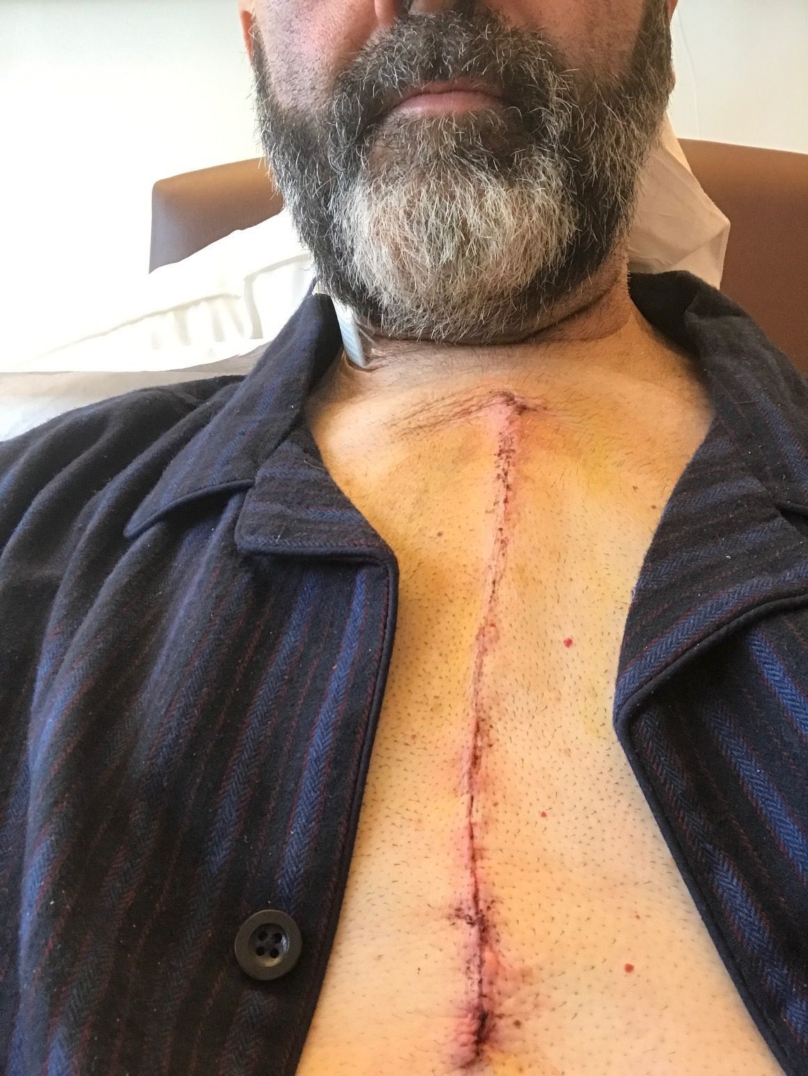 Think this is a pretty neat scar - Surgeon was Alastair Graham from Belfast.