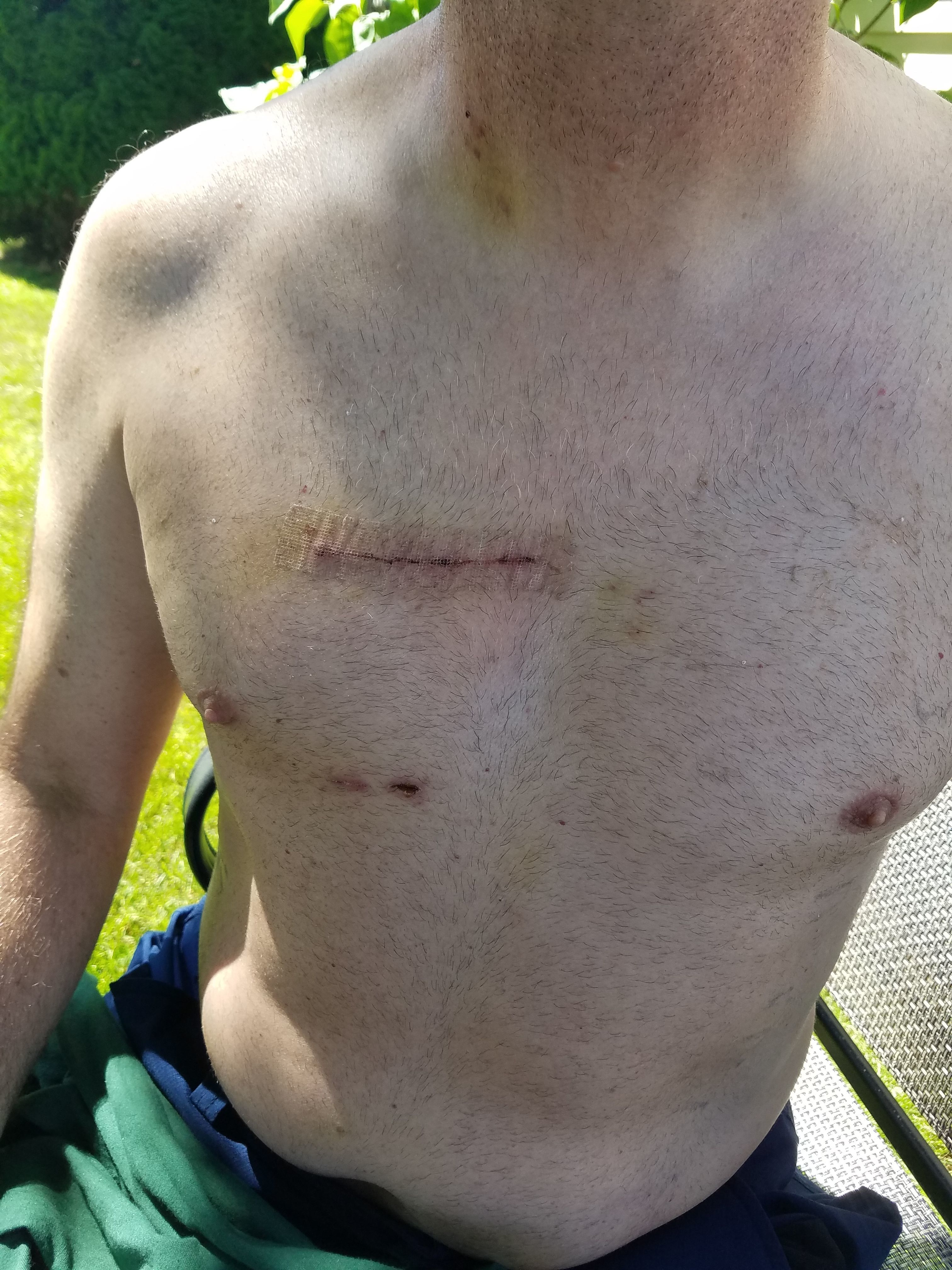 Incision 1 week post ARV Surgery. Not too bad.