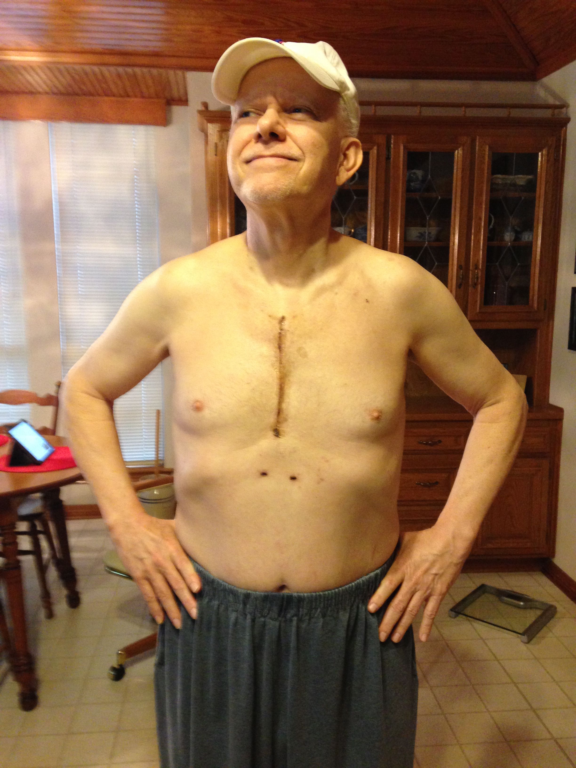 23 days after valve replacement and aneurysm repair.....sternotomy....no complications so far....Thanks to Dr. Schaffer and Dr. Will H. Ryan at Baylor Plano Heart Hospital in Plano, TX.....the best of the best!