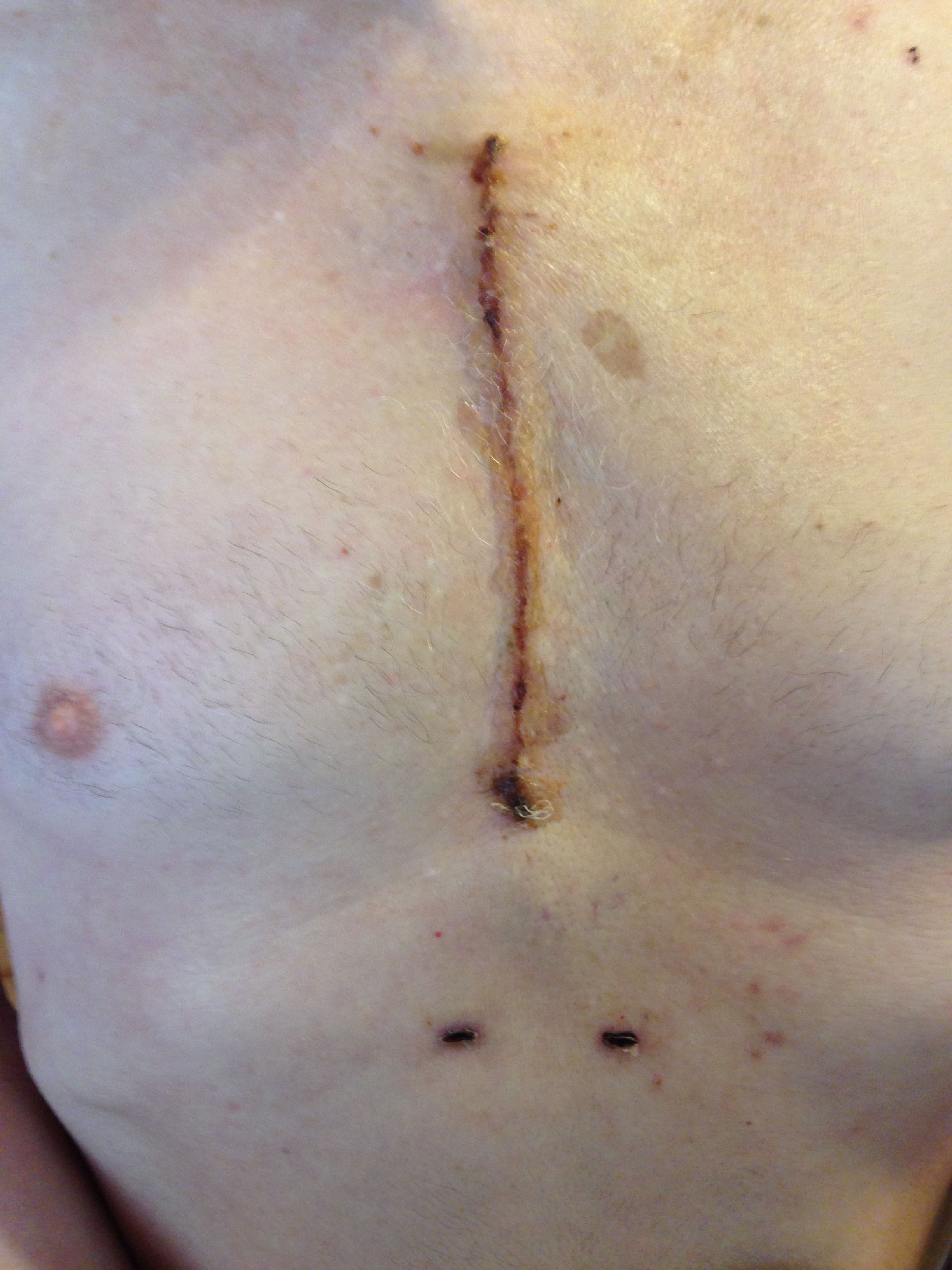 Three weeks post surgery
