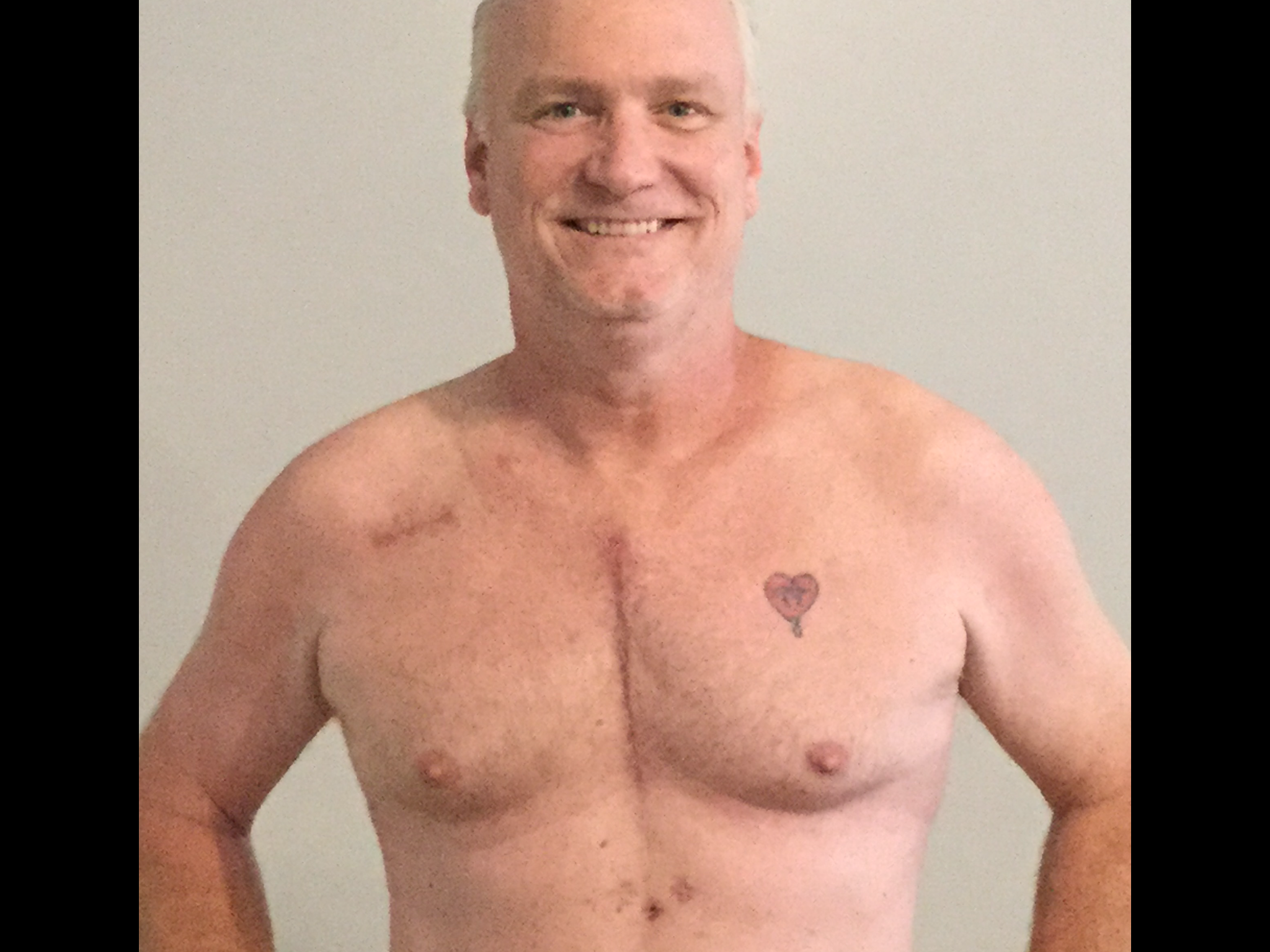 1 Month Post Op.