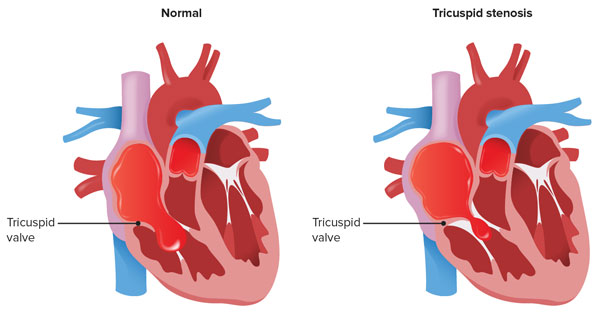 Tricuspid Stenosis