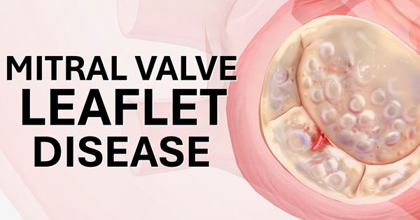 Mitral Valve Leaflets