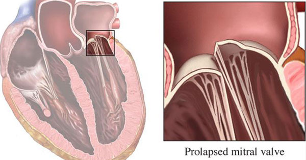 Mitral Valve Disorder