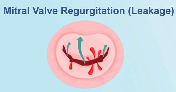 Mitral Valve Regurgitation