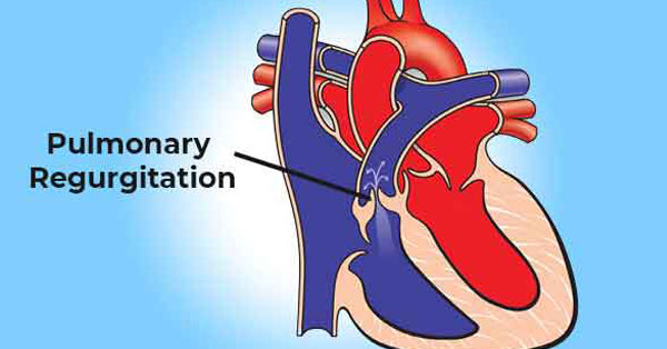 Pulmonary Regurgitation