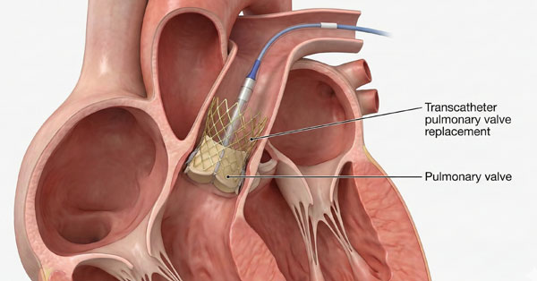 Pulmonary Valve Replacement