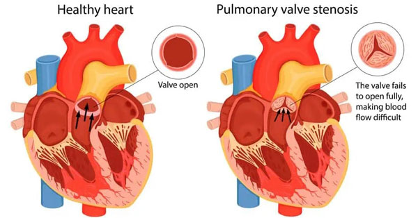 Pulmonary Valve Stenosis