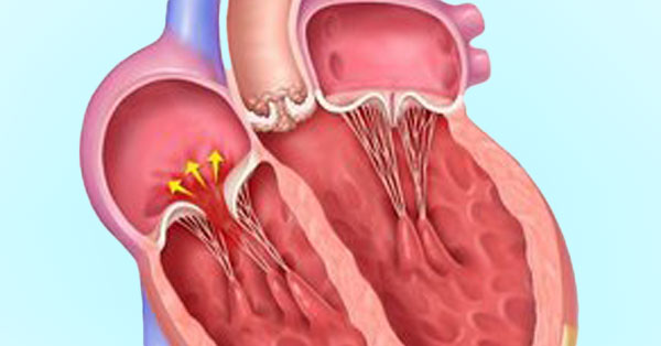 Tricuspid Regurgitation