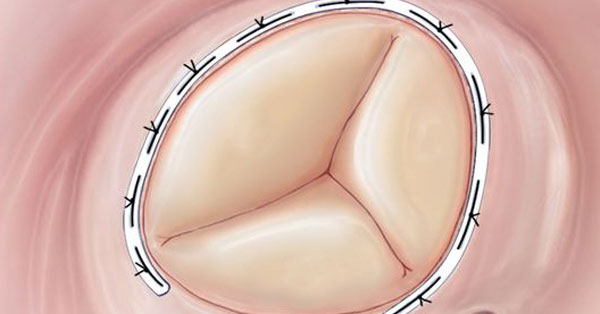 Tricuspid Valve Repair