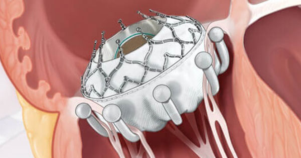 Transcatheter Tricuspid Valve Replacement