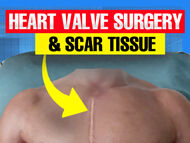 Surgeon Q&A: Scar Tissue and Minimally Invasive Heart Valve Reoperations
