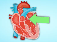 Patient Webinar: Advances in Congenital Aortic Valve Disease