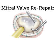 Mitral Valve Re-Repair: A "Super-Specialty" Discussed with Dr. David Adams