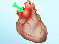 Patient Webinar: Advances in Aortic Valve & Aneurysm Surgery