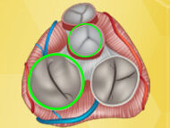 Surgeon Q&A: Multiple Minimally-Invasive Heart Valve Surgery with Dr. Eric Weiss