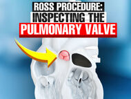 Ross Procedure Insights: Inspecting the Pulmonary Valve