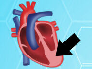 Hypertrophic Cardiomyopathy Explained for Heart Valve Patients