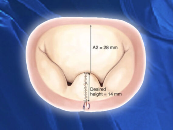 Surgeon Q&A: Patient Criteria to Choose Your Mitral Surgeon