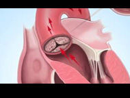Fact or Fiction: Aortic Stenosis Can Be Fatal?